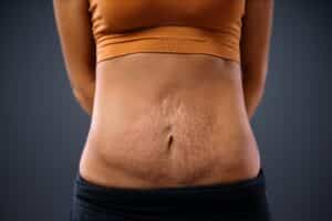 Does Tummy Tuck Surgery Remove Stretch Marks Beauty By Brueck